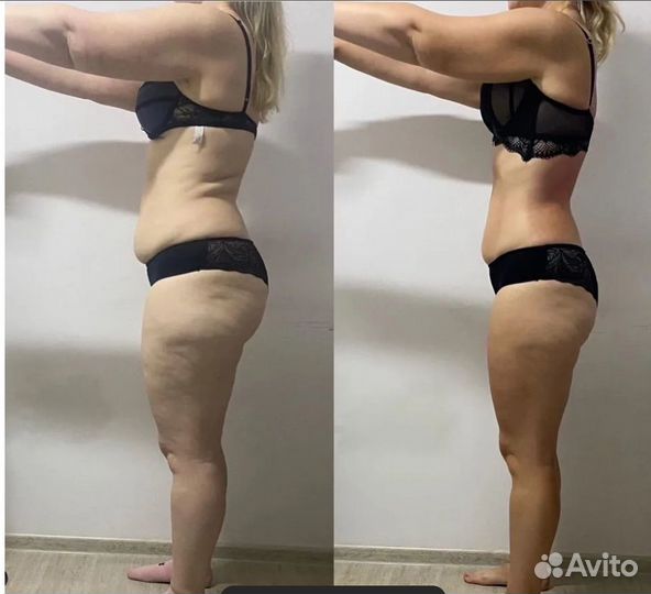 Плоский живот - размер за 1 процедуру в Казани