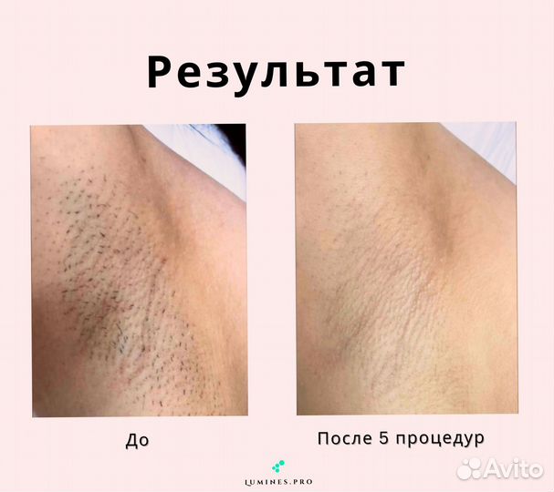 Аппарат для эпиляции Lumines MaxOne 1200W