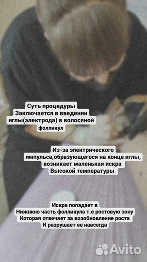 Электроэпиляция