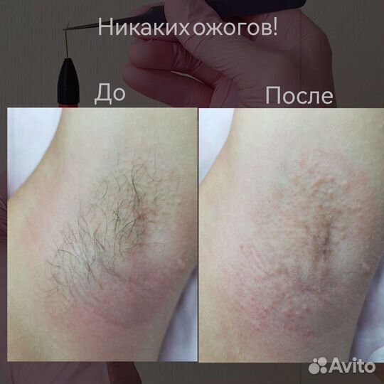 Электроэпиляция
