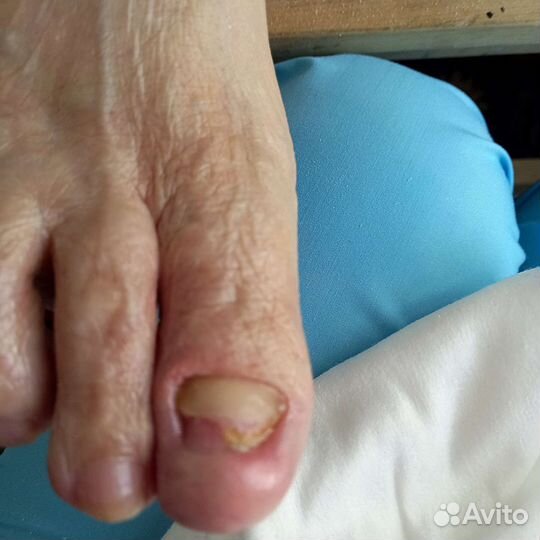 Медицинский педикюр на дому