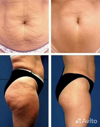 Липосакция похудение на Липсоникс или жиротоп