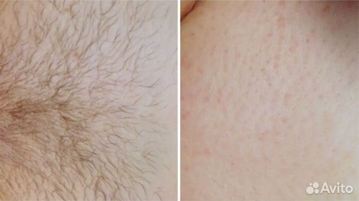 Модели / лазерная эпиляция / депиляция