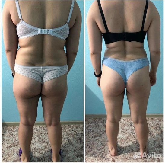 Ищем моделей на подтяжку животика