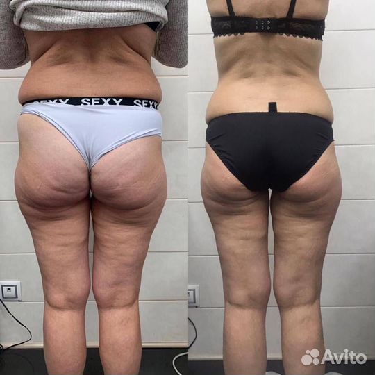 Эффективное похудение / коррекция фигуры