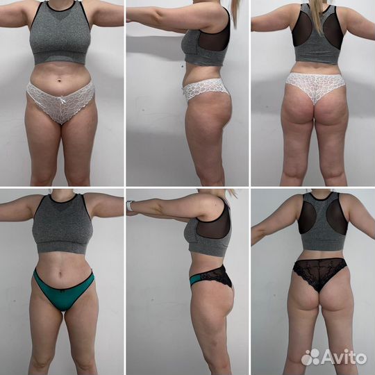 Похудение/Антицеллюлитный массаж/Массаж