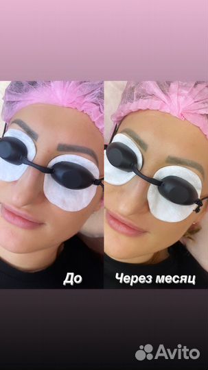 Лазерное удаление тату