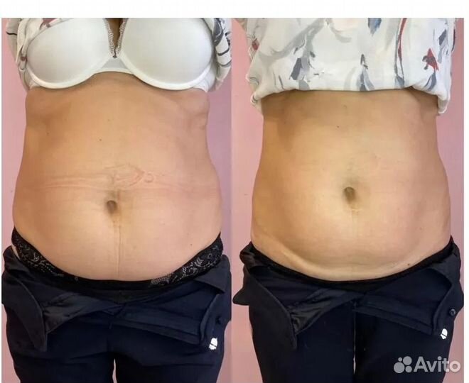 Липосакция без операции в Тольятти