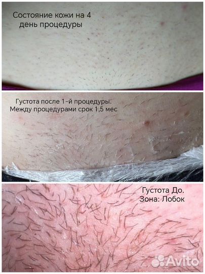 Электроэпиляция