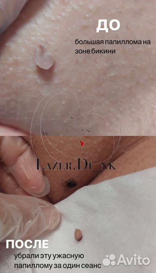 Лазерная эпиляци, холодная плазма, массаж