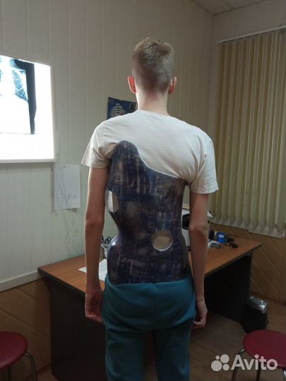 Корсет - Орто лечение сколиоза корсетом Шено