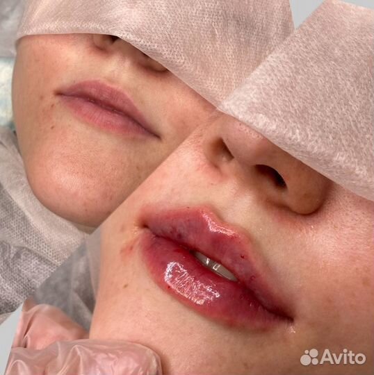 Увеличение губ