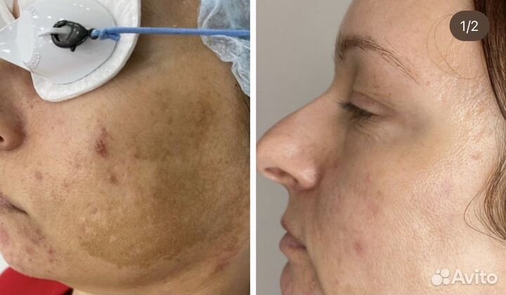 Фотоомоложение лечение постакне сосудов lumecca