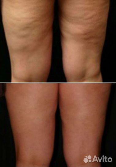 Антицеллюлитный массаж