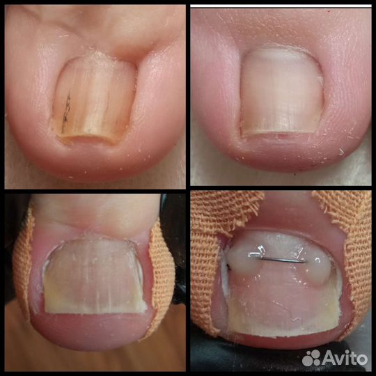 Подолог, вросший ноготь, сложный педикюр