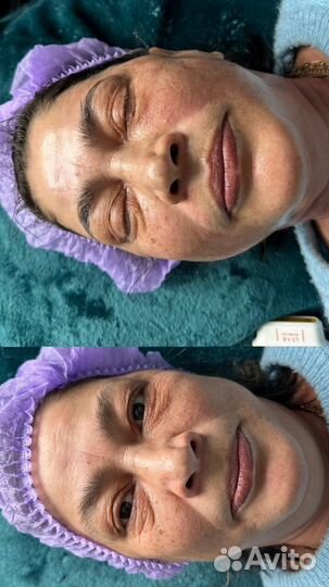 SMAS лифтинг подольск