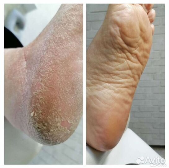 Коррекция вросшего ногтя, медицинский педикюр