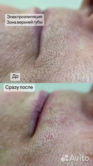 Электроэпиляция