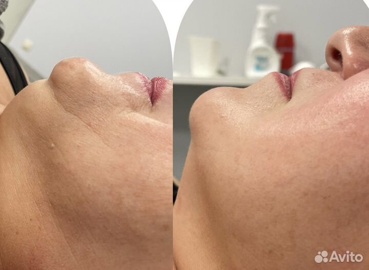 Аппаратное похудение Коррекция фигуры