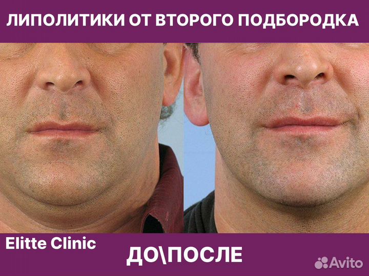 Косметолог худое лицо липолитики