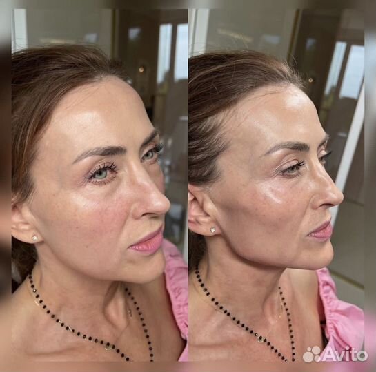 Full face, косметолог обучение, увеличение губ