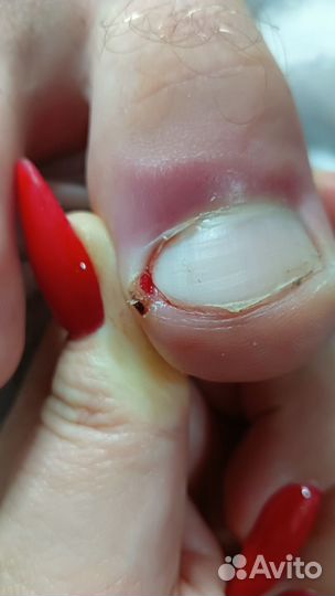 Подолог,вросший ноготь, стержневые мозоли