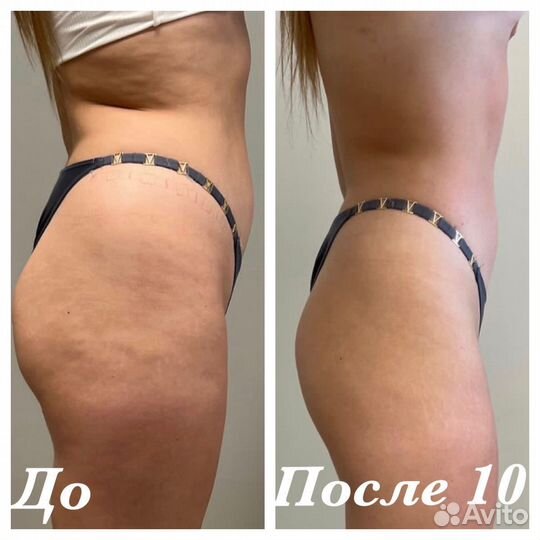 Аппаратный и ручной массажи