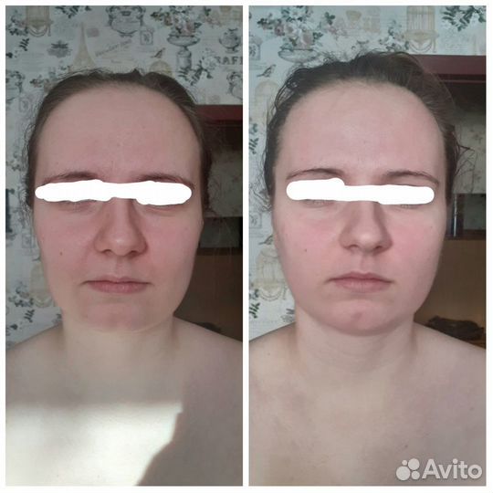 Антицеллюлитный массаж, классический, массаж лица