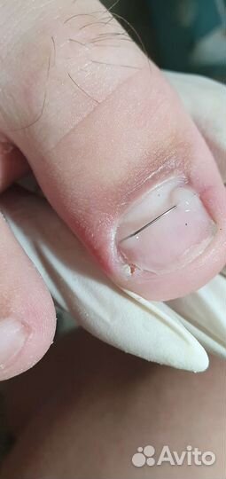 Лечение вросших ногтей
