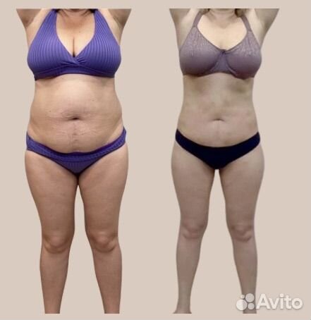 Аппаратное похудение