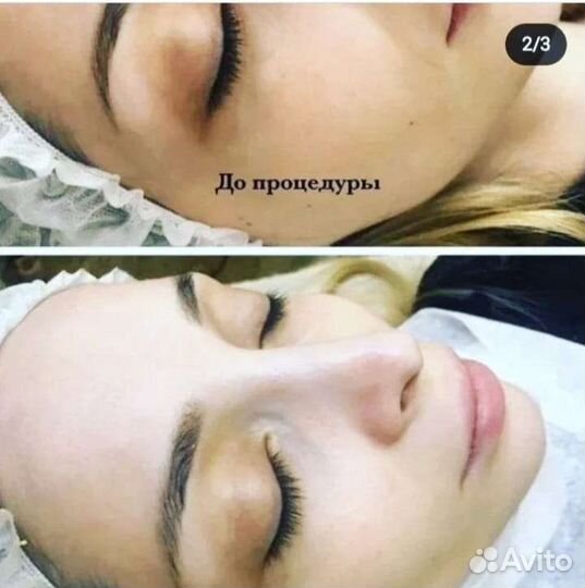 Процедура Фарфоровая куколка