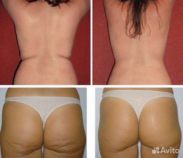 Антицеллюлитный массаж