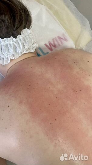 Антицеллюлитный массаж