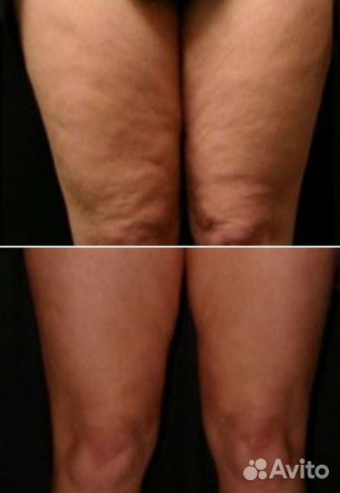 Антицеллюлитный массаж