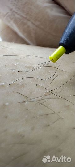 Электроэпиляция в центре