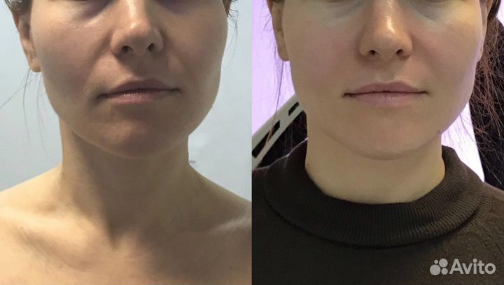 Холодная плазма