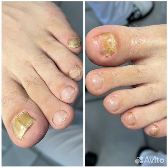 Педикюр + подолог