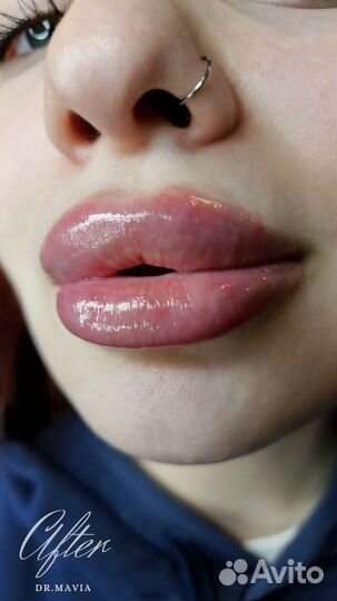 Увеличение губ