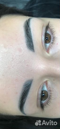 Лазерное удаление пм и татуировок