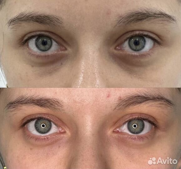 Коррекция носослезной борозды