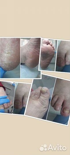 Педикюр медицинский (подолог)с выездом на дом