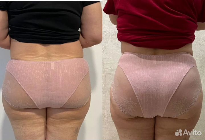 LPG массаж в Перми Оригинальный бразильский LPG