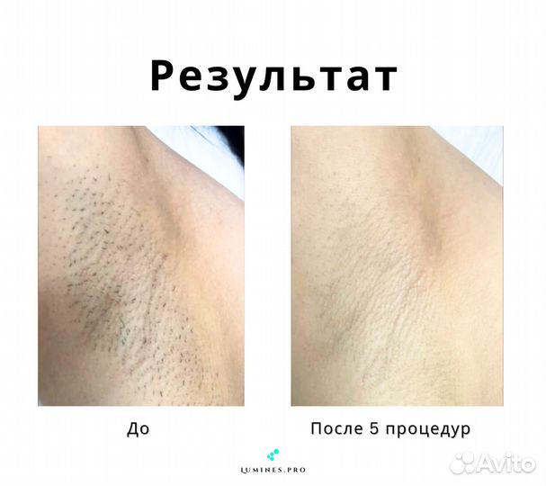 Диодный лазер для эпиляции «Lumines» Макс Ван 1200W