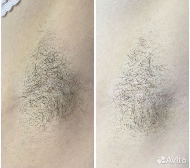 Электроэпиляция