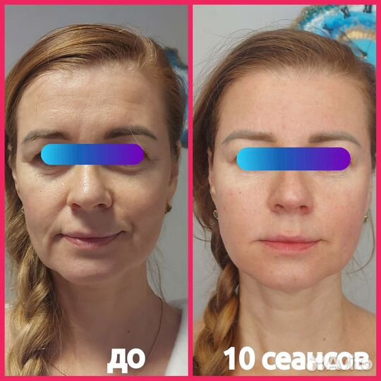 Буккальный-Скульптурный-Миофасциальный Массаж Лица