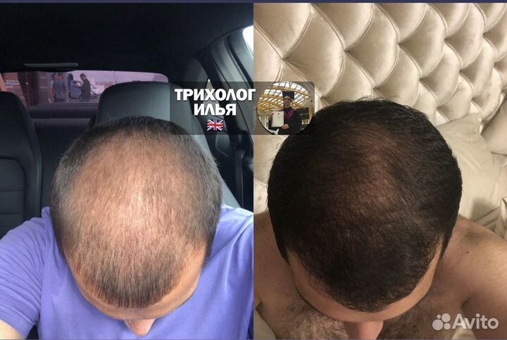 Трихолог (Остановлю Облысение) дистанционный