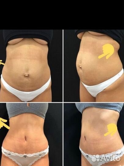 Криолиполиз модель на похудение