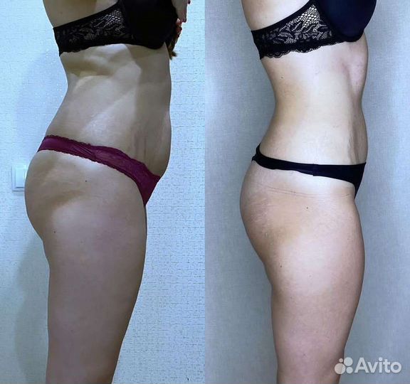 Vela Shape RF курс Безлимит летний