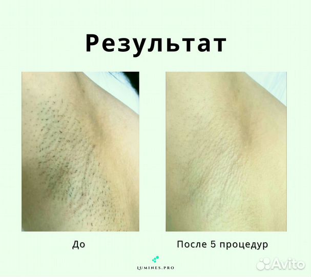 Диодный лазер Lumines MaxOne 1200