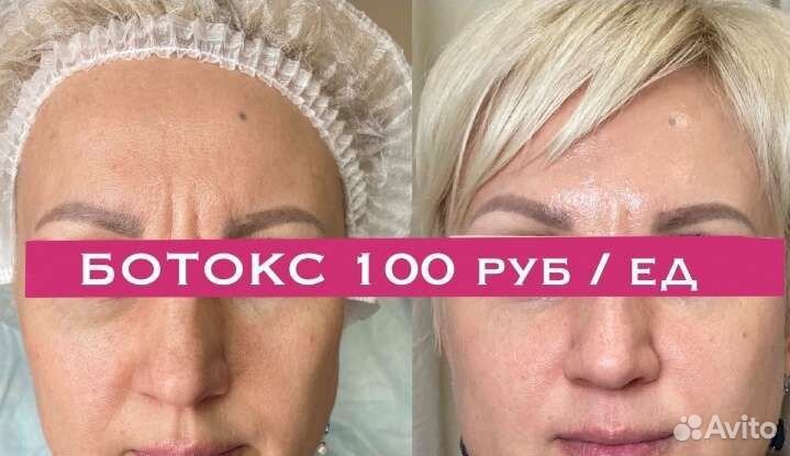 Модель на ботокс лица